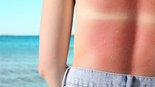 Adult Burns in Australia: Common Causes, Complications and Essential First Aid - Assurance First Aid Kits