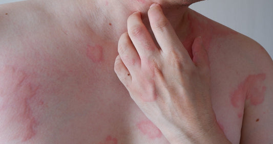 BLOG anaphylactic rash on mans hand and chest