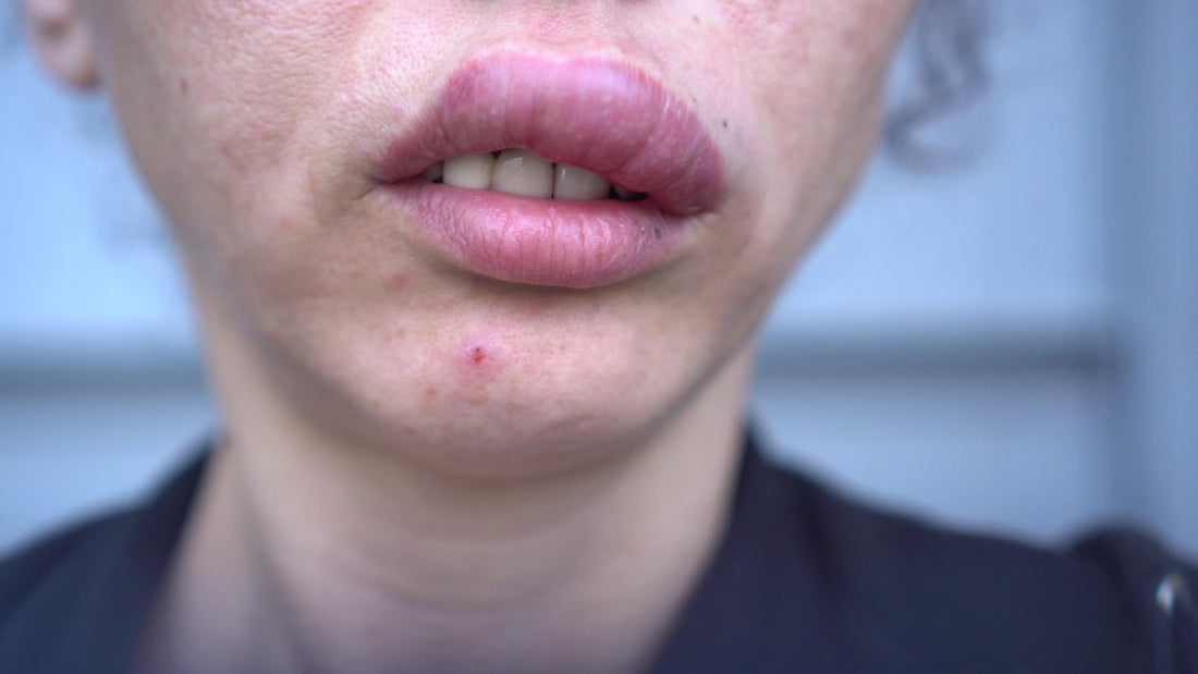 Person suffering an anaphylactic reaction with swollen lips.