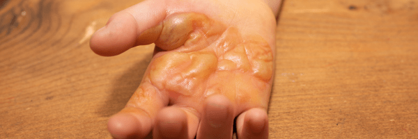 BLOG hand with severe blistered burn injury