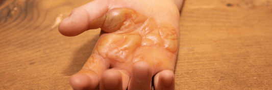 BLOG hand with severe blistered burn injury