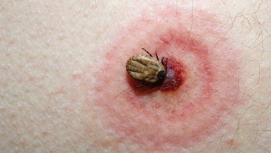 How to Safely Remove a Tick - Assurance First Aid Kits