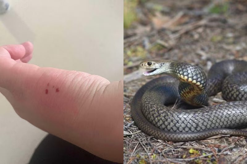BLOG snake bite marks on a childs hand (LEFT IMAGE) brown snake (right image)